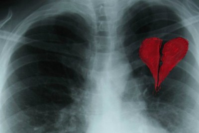 ραγισμένη καρδιά σε μια ακτινογραφία θώρακος