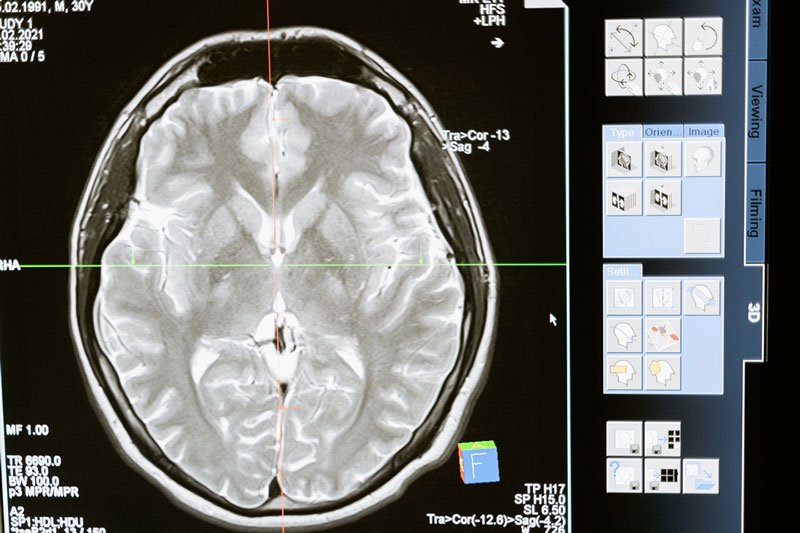 εξέταση εμφανίζει ότι το Prozac αλλάζει τη λιπιδική σύνθεση του εγκεφάλου