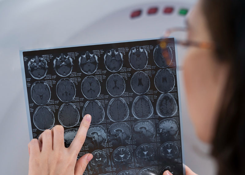 επιστήμονας εντοπίζει νέες νευρωνικούς οδούς για τη νόσο του Αλτσχάιμερ
