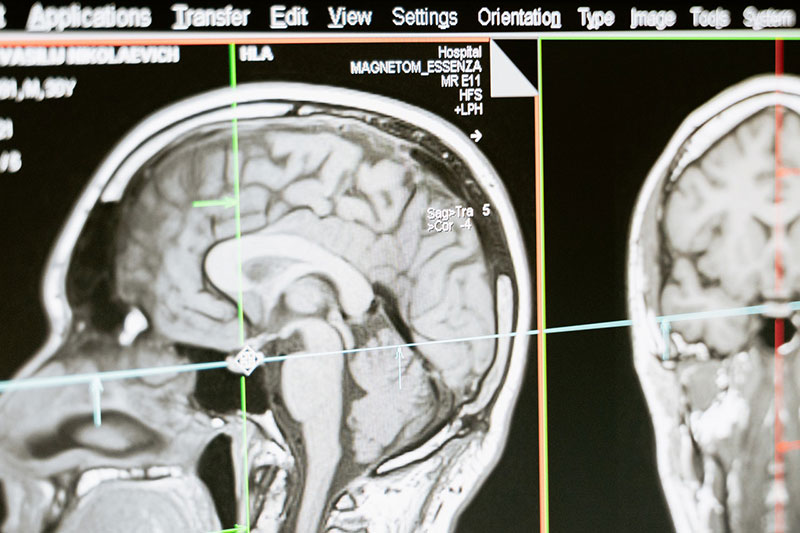 τομογραφία εγκεφάλου δείχνει ένα πρωτοποριακό εγκεφαλικό εμφύτευμα που θεραπεύει τη σοβαρή κατάθλιψη