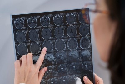ερευνήτρια κοιτάζει μαγνητική τομογραφία εγκεφάλου