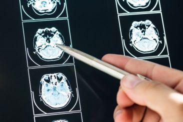 Η σε βάθος ηλεκτρική διέγερση του εγκεφάλου είναι αποτελεσματική κατά της σοβαρής IΨΔ